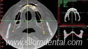 Nobel Guide CT Scan for Implants