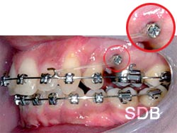 Miniscrews Orthodontics