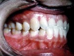 Before Orthodontic treatment