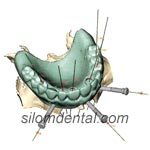 NobelGuide in Dental Thailand