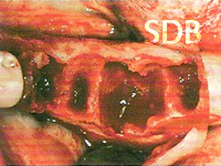 Occlusal view after opening the defect