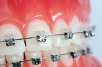 damon braces bangkok in dental orthodontics thailand