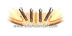implant All-on-4 lower jaw