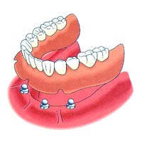 4 Implants + Ball + Overdenture