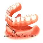 2 Implants + Bar attachment + Overdenture