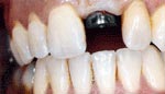 Before dental implants replacement of a single tooth