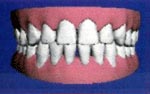 After  Invisalign treatment