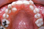 Before Lingual Orthodontics