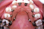 During Lingual Orthodontics