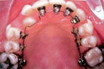 During Lingual Orthodontics