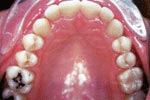 After Lingual Orthodontics