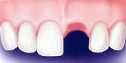 Dental Bridges procedues