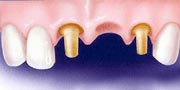 Dental Bridges procedues