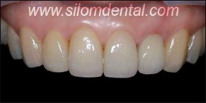 After Porcelain Veneers, Veneers Dental Clinic Thailand