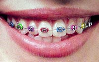 metal braces bangkok in dental orthodontics thailand
