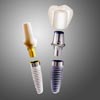 Replace SelectTapered Dental Implants